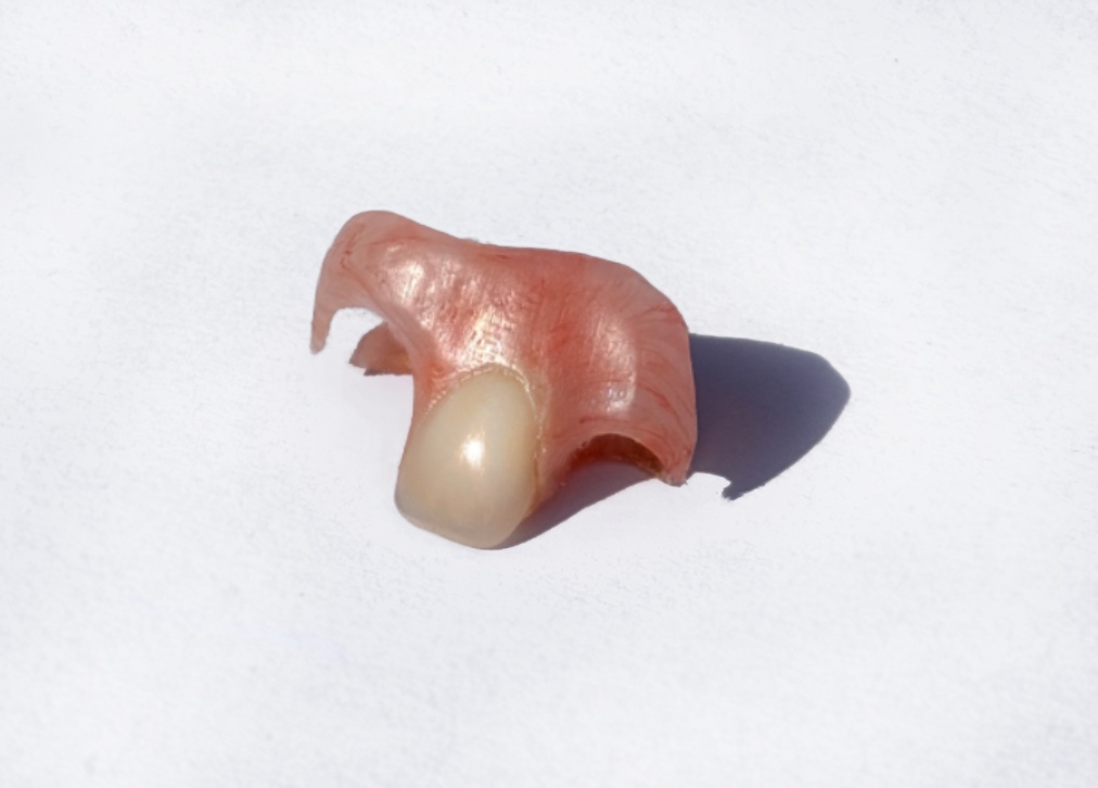 Image représentant un ackers dentaire réalisé au laboratoire JC Anjou Dental.