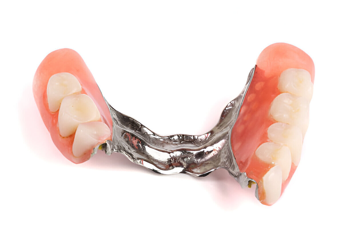 Prothèse dentaire amovible fabriquée et ajustée par JC Anjou Dental à Angers.
